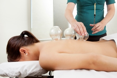 10988896 - acupuncture therapist placing a cup on the back of a female patient